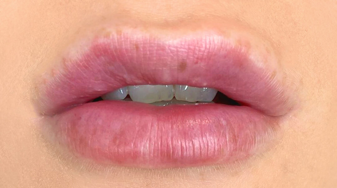 hot to avoid dermal filler migration