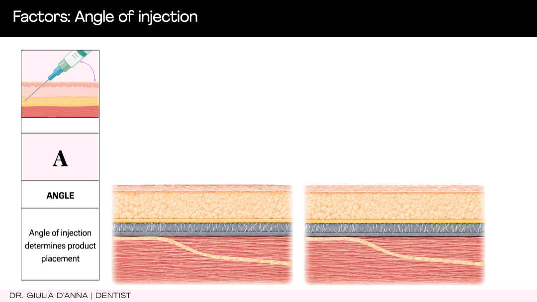 Needle angle for botulinum toxin injection