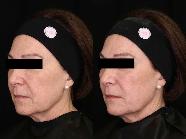 Chin balance and lower face proportions