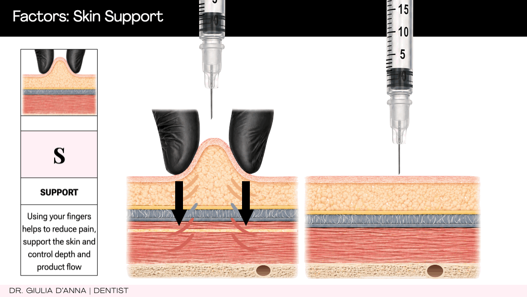 Using the non-injecting hand to support tissues during botulinum toxin injection