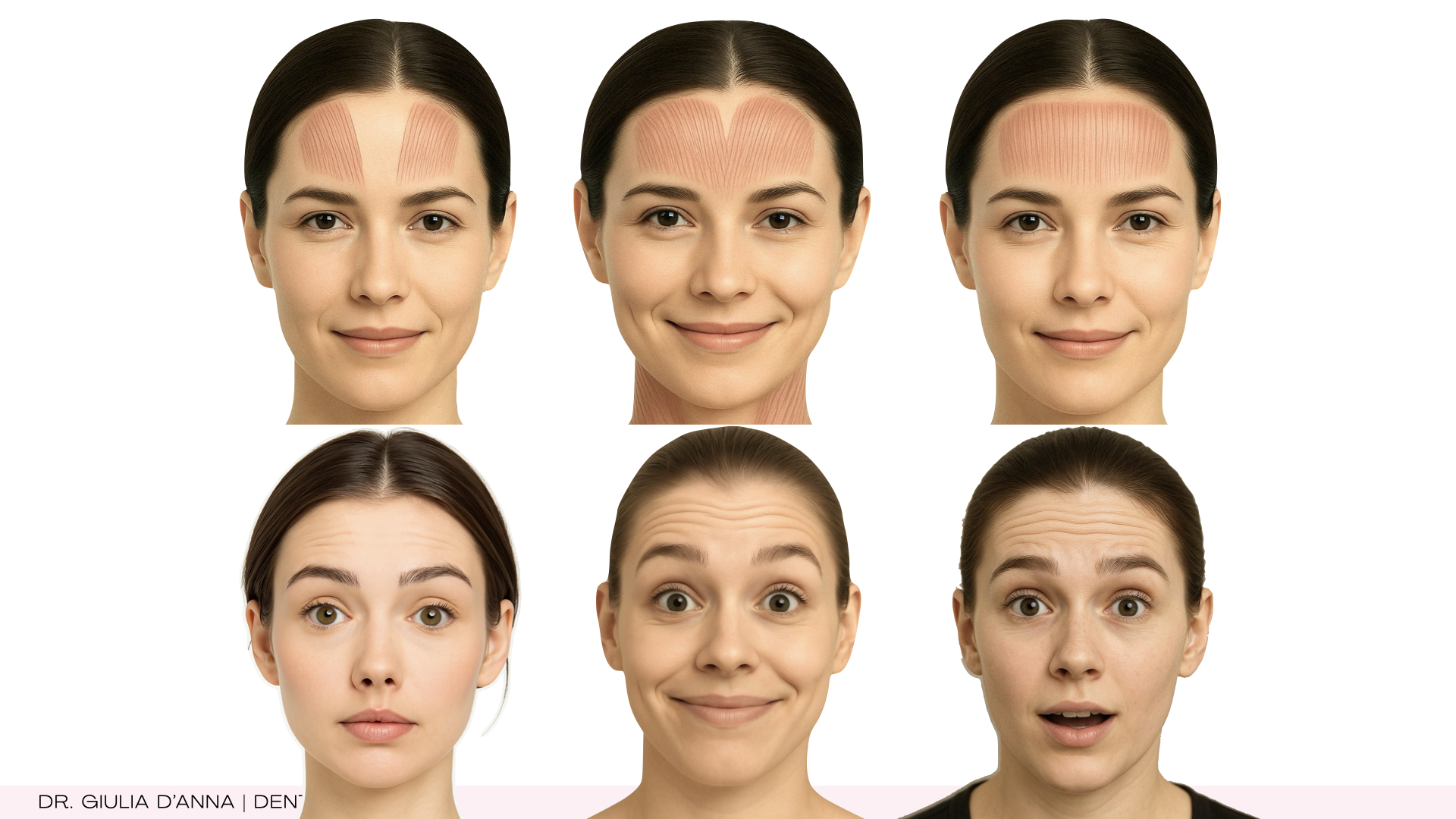 Forhead-frontalis-pattern-types