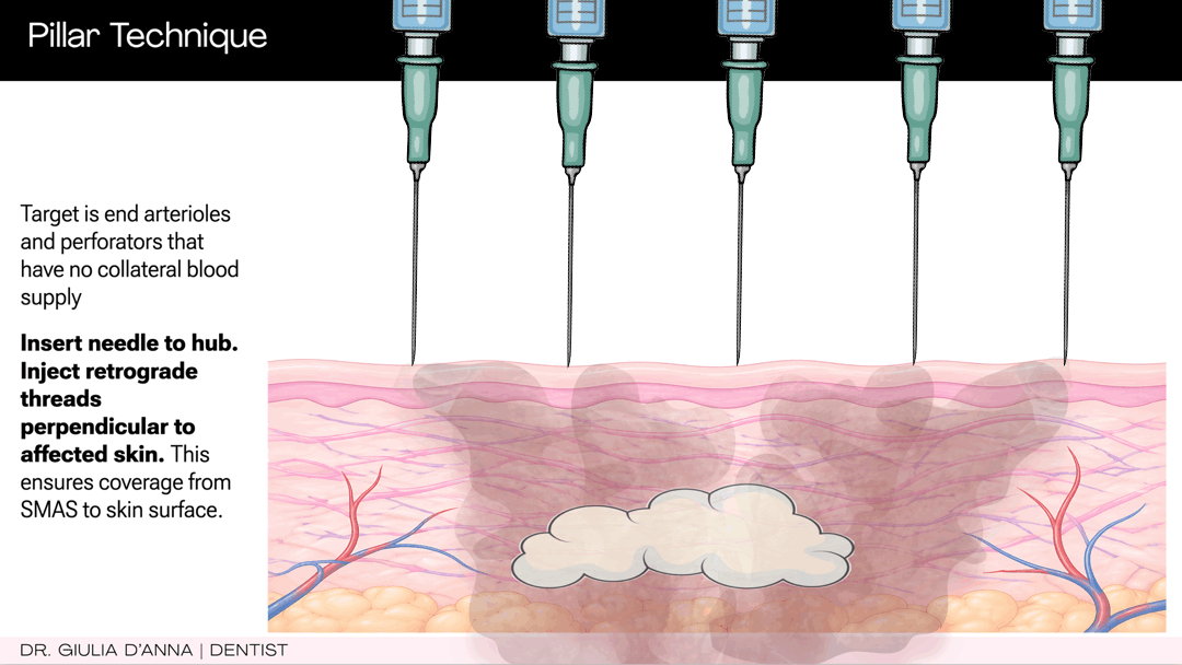How hyaluronidase acts on hyaluronic acid filler