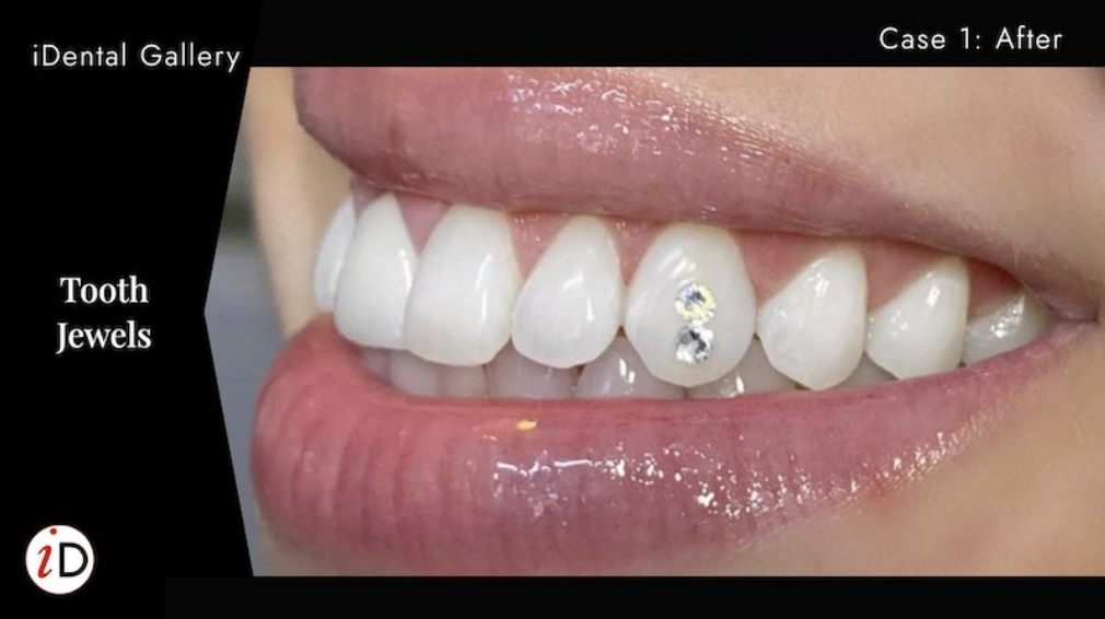 Tooth jewel placement at iDental Balwyn North