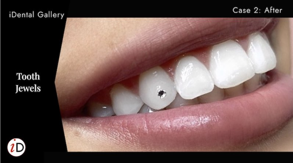 Tooth gem bonded at iDental Balwyn North